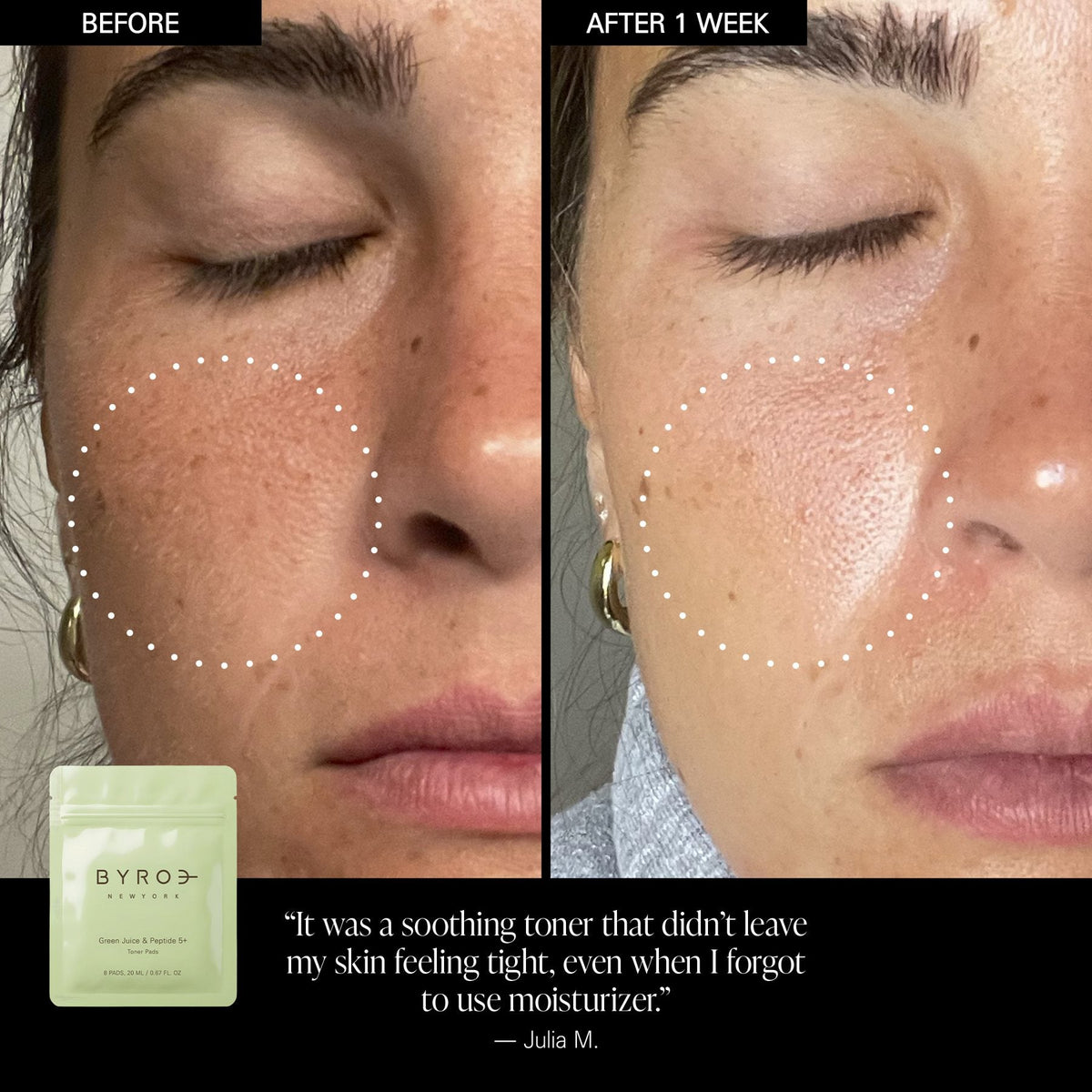 Before and after one week of using Green Juice & Peptide 5+ Toner Pads